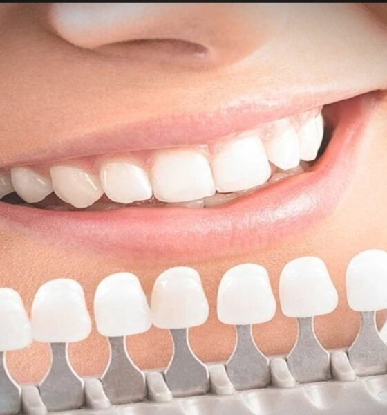 best teeth whitening kit