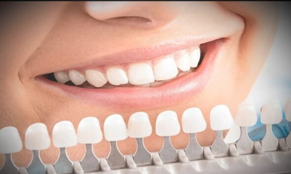 best teeth whitening kit