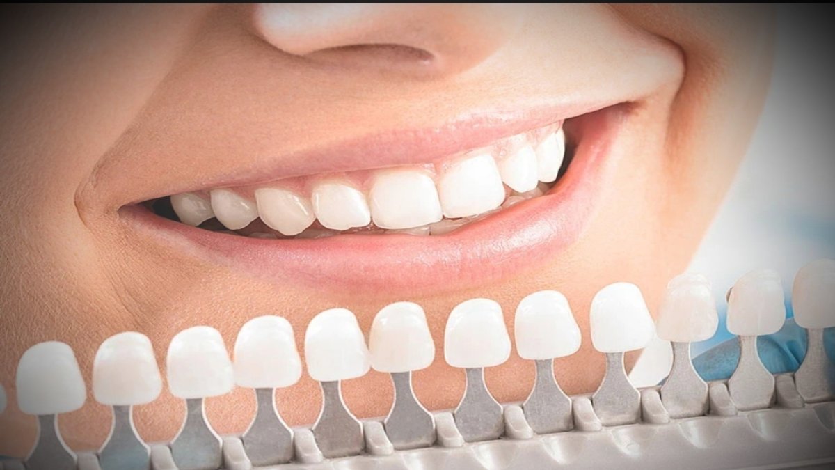 best teeth whitening kit